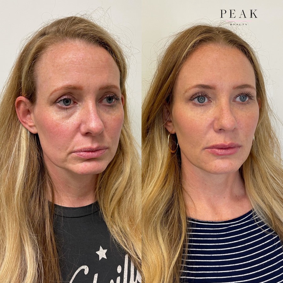 Before and after, Peak Beauty patient 6, angled view