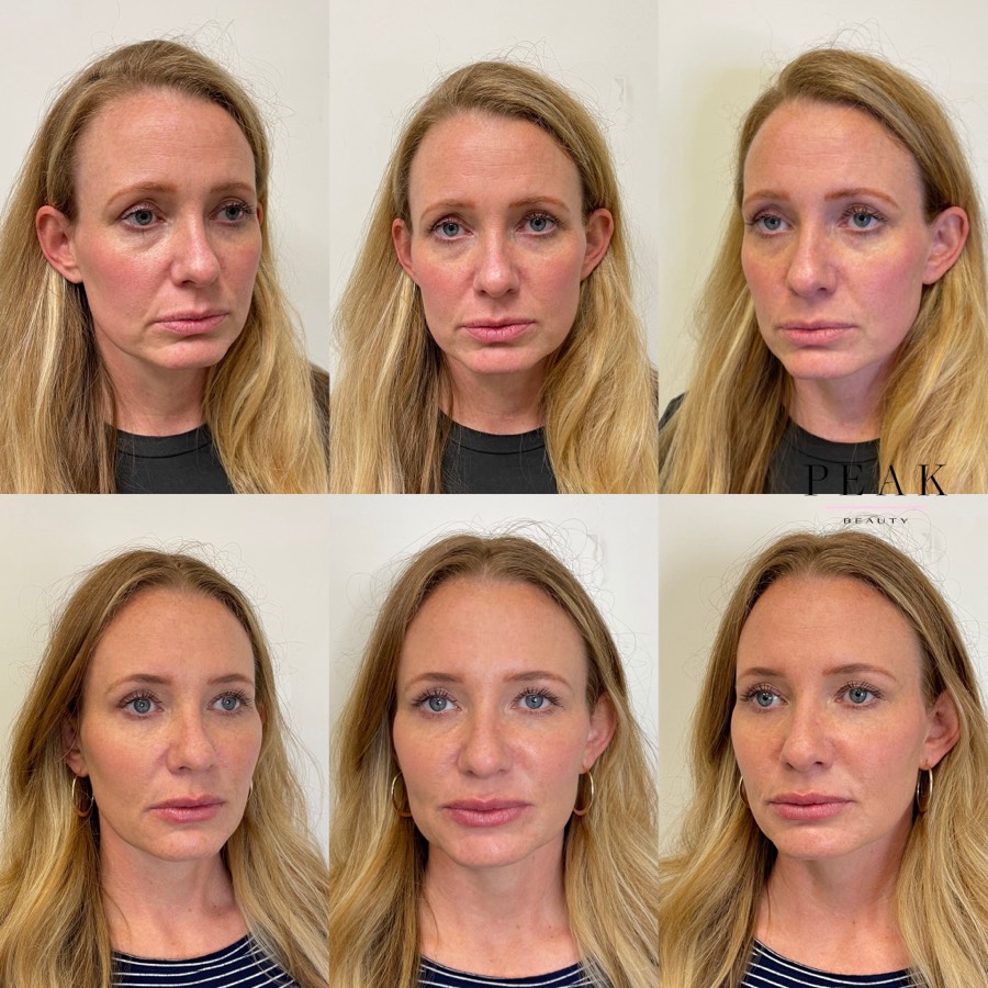 Before and after, Peak Beauty patient 6, every angle