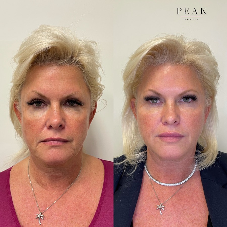 Before and after, Peak Beauty patient 1, front view